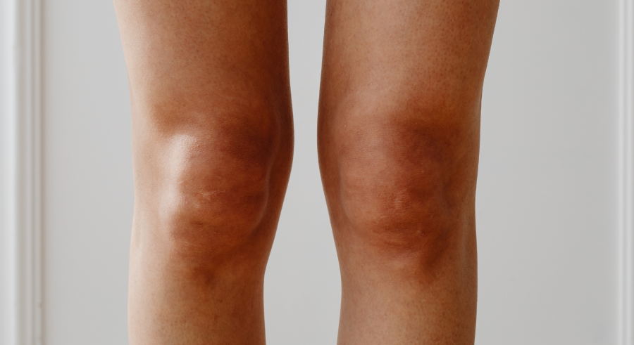 robotic-knee-replacement-bow-legs-surgical-planning