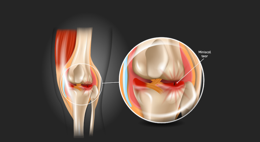 Meniscus Tear Treatment Without Surgery: What Orthopaedic Specialists Consider Before Recommending an Operation